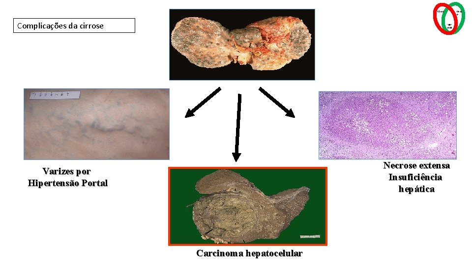 Básico Complicações da cirrose Clínic o MSP 4211 Necrose extensa Insuficiência hepática Varizes por