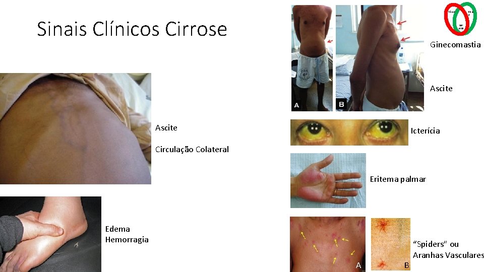 Básico Sinais Clínicos Cirrose Clínic o MSP 4211 Ginecomastia Ascite Icterícia Circulação Colateral Eritema