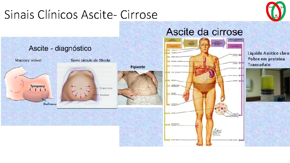 Sinais Clínicos Ascite- Cirrose Piparote Básico Clínic o MSP 4211 Líquido Ascítico claro Pobre