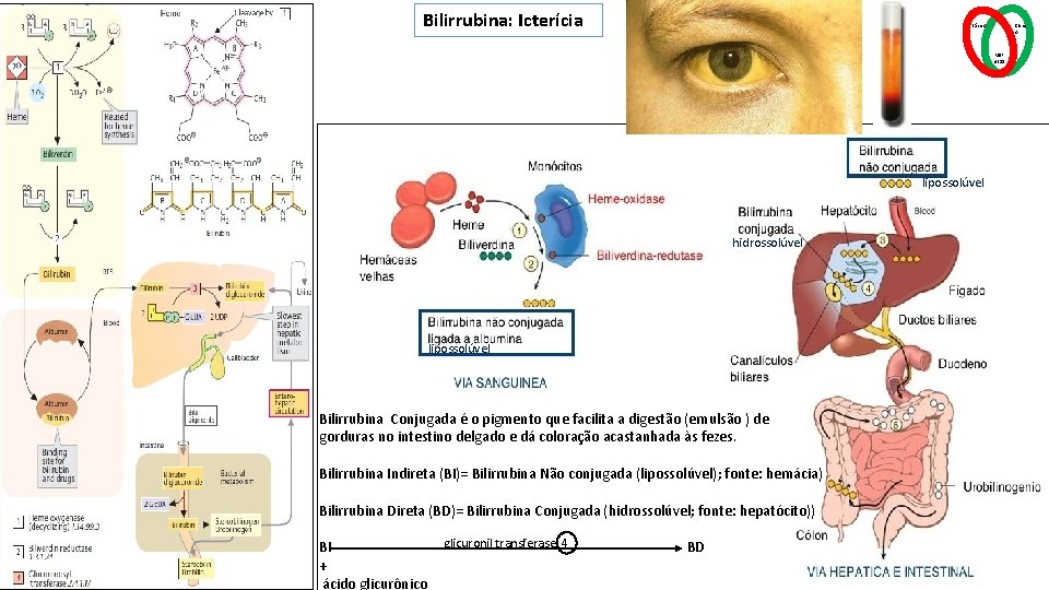 Bilirrubina: Icterícia Básico Clínic o MSP 4211 lipossolúvel hidrossolúvel lipossolúvel Bilirrubina Conjugada é o