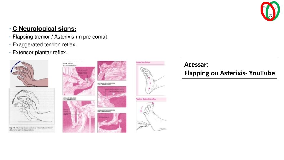 Básico Clínic o MSP 4211 Acessar: Flapping ou Asterixis- You. Tube 