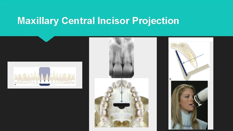 Maxillary Central Incisor Projection 