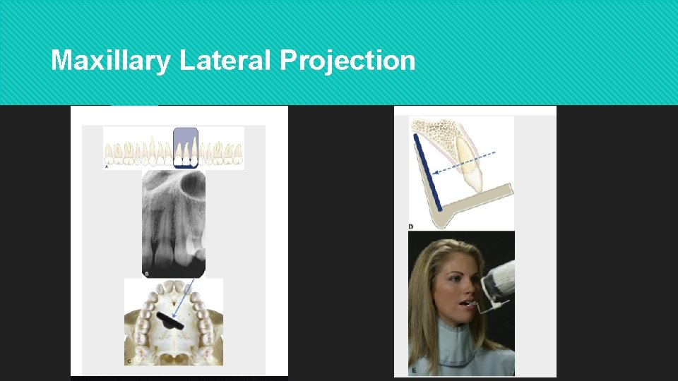 Maxillary Lateral Projection 