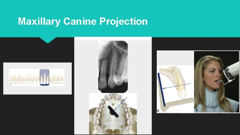 Maxillary Canine Projection 