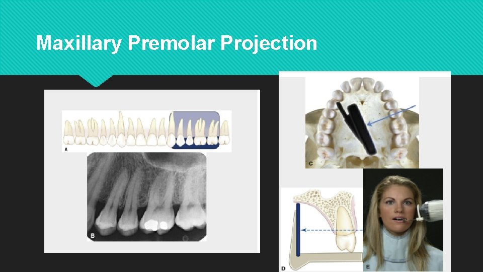 Maxillary Premolar Projection 