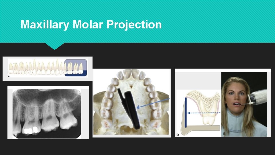 Maxillary Molar Projection 