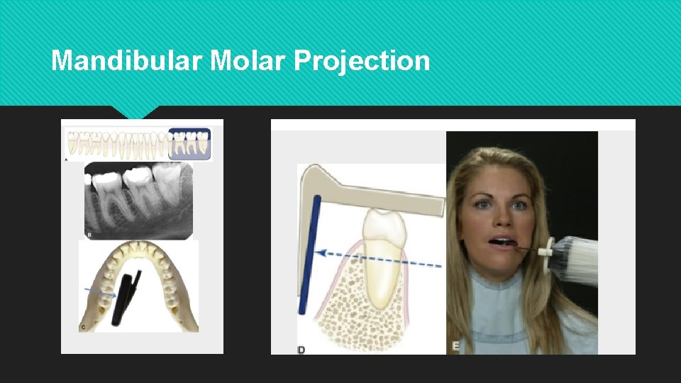 Mandibular Molar Projection 