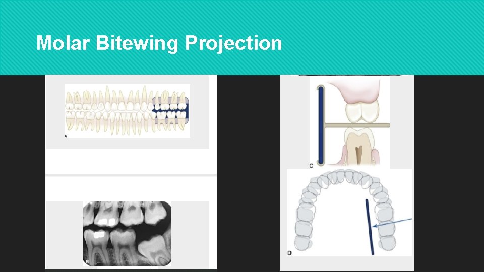 Molar Bitewing Projection 