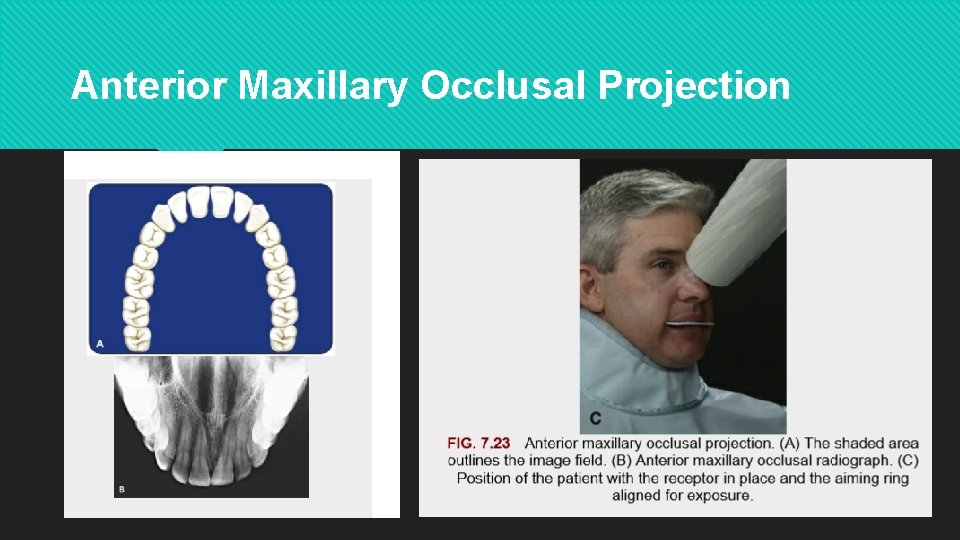 Anterior Maxillary Occlusal Projection 