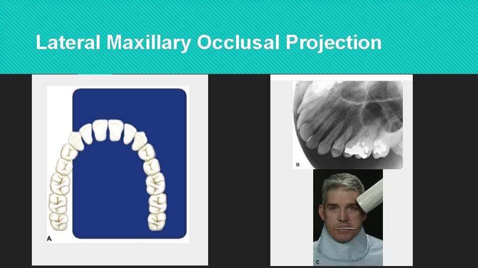 Lateral Maxillary Occlusal Projection 