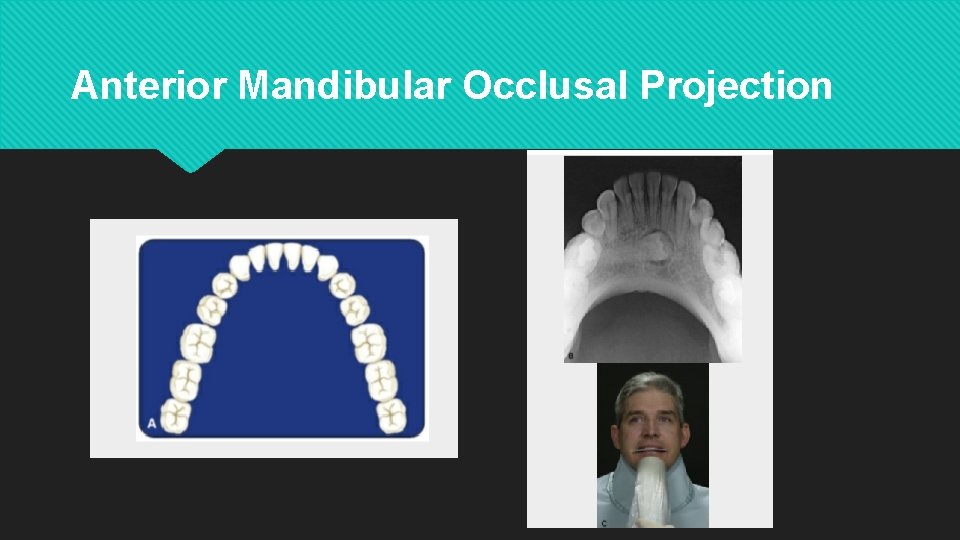 Anterior Mandibular Occlusal Projection 