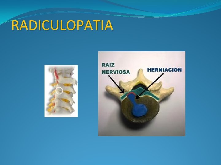 RADICULOPATIA 