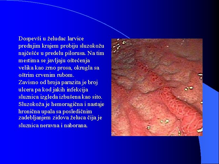 Dospevši u želudac larvice prednjim krajem probiju sluzokožu najčešće u predelu pilorusa. Na tim