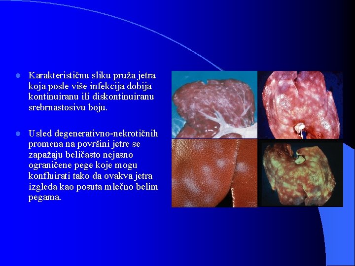 l Karakterističnu sliku pruža jetra koja posle više infekcija dobija kontinuiranu ili diskontinuiranu srebrnastosivu