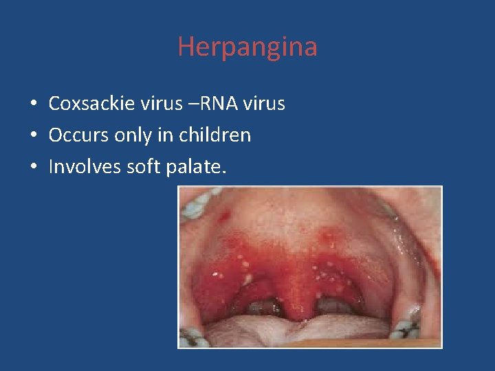 Herpangina • Coxsackie virus –RNA virus • Occurs only in children • Involves soft