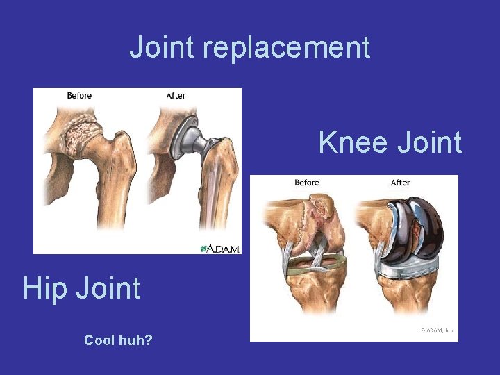 Joint replacement Knee Joint Hip Joint Cool huh? 