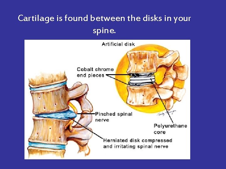 Cartilage is found between the disks in your spine. 