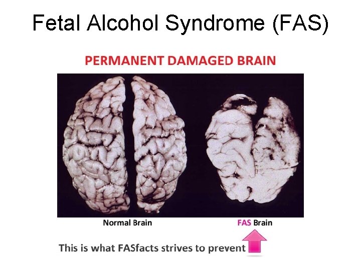 Fetal Alcohol Syndrome (FAS) 