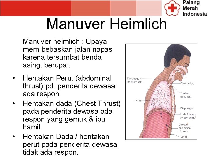 Manuver Heimlich Manuver heimlich : Upaya mem-bebaskan jalan napas karena tersumbat benda asing, berupa