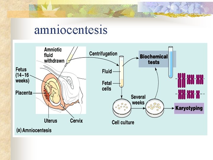 amniocentesis amniocentesis