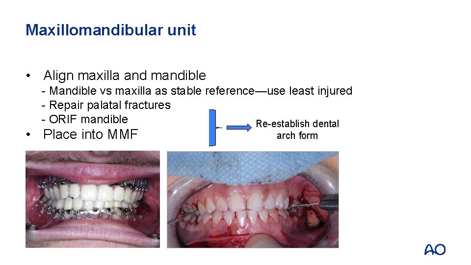 Maxillomandibular unit • Align maxilla and mandible - Mandible vs maxilla as stable reference—use