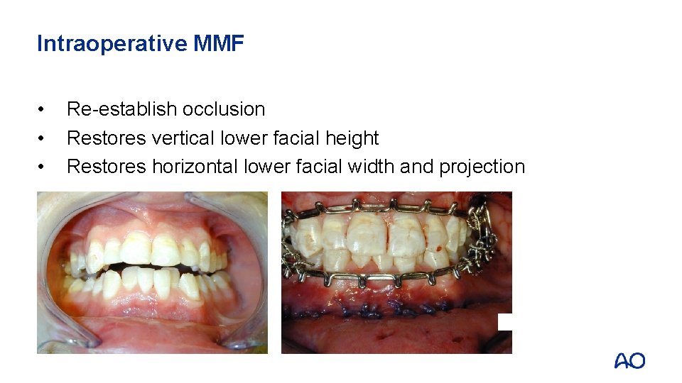 Intraoperative MMF • • • Re-establish occlusion Restores vertical lower facial height Restores horizontal