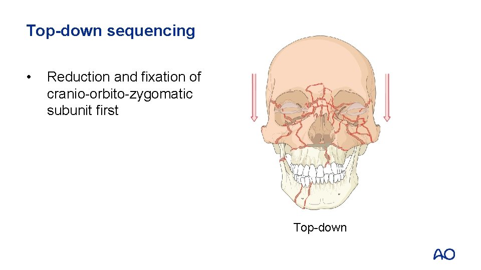 Top-down sequencing • Reduction and fixation of cranio-orbito-zygomatic subunit first Top-down 