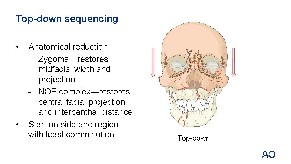 Top-down sequencing • • Anatomical reduction: - Zygoma—restores midfacial width and projection - NOE