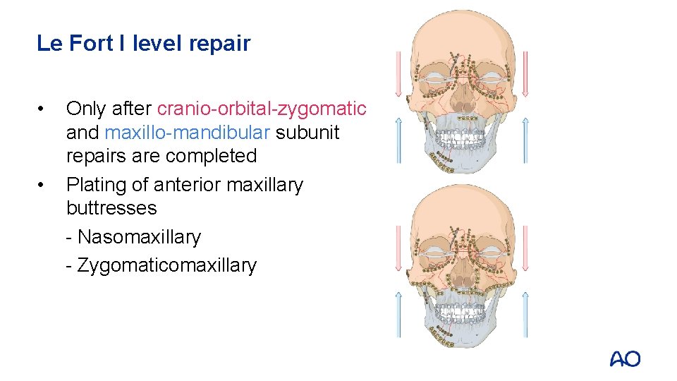 Le Fort I level repair • • Only after cranio-orbital-zygomatic and maxillo-mandibular subunit repairs