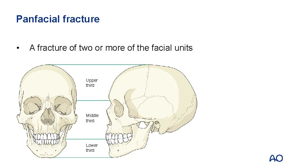 Panfacial fracture • A fracture of two or more of the facial units Upper