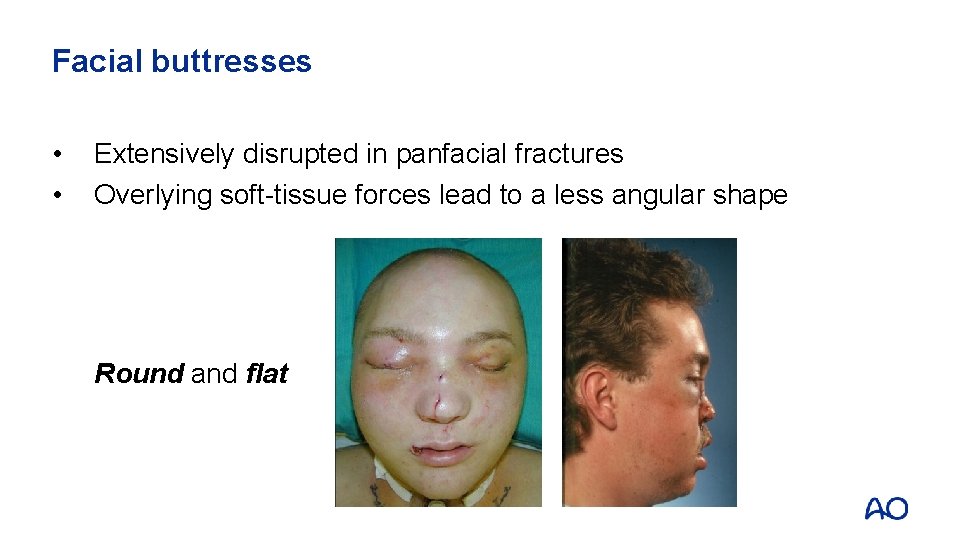 Facial buttresses • • Extensively disrupted in panfacial fractures Overlying soft-tissue forces lead to