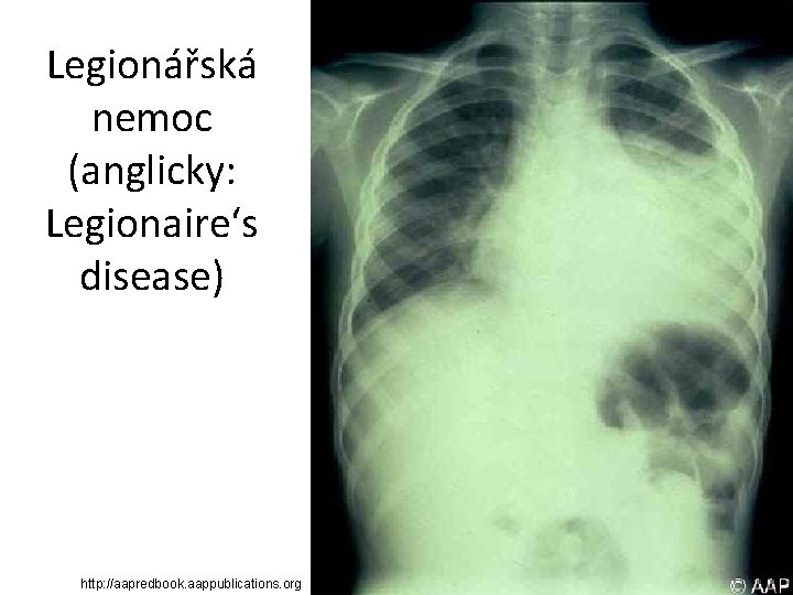 Legionářská nemoc (anglicky: Legionaire‘s disease) http: //aapredbook. aappublications. org 