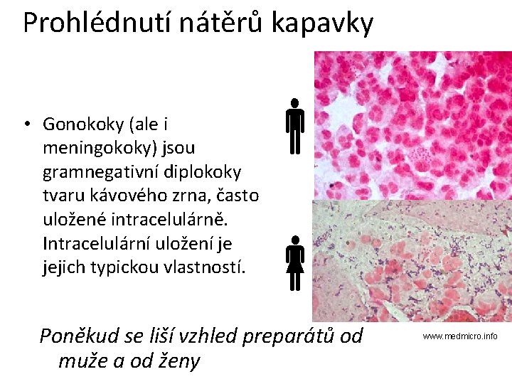 Prohlédnutí nátěrů kapavky • Gonokoky (ale i meningokoky) jsou gramnegativní diplokoky tvaru kávového zrna,