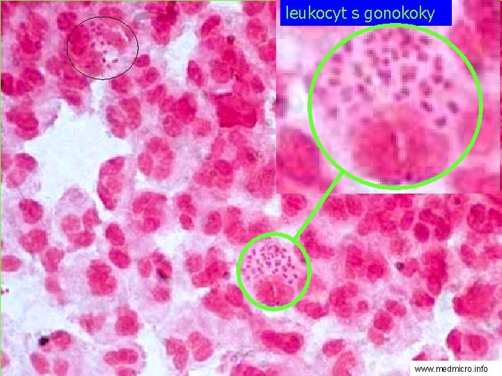 leukocyt s gonokoky www. medmicro. info 