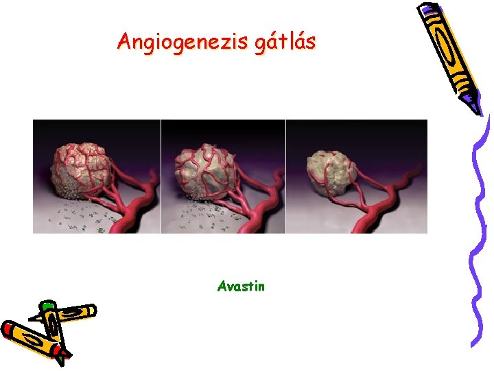 Angiogenezis gátlás Avastin 