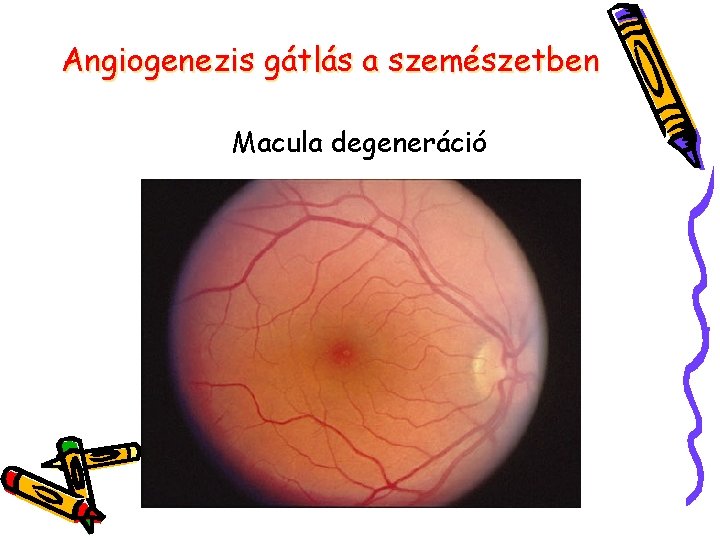 Angiogenezis gátlás a szemészetben Macula degeneráció 