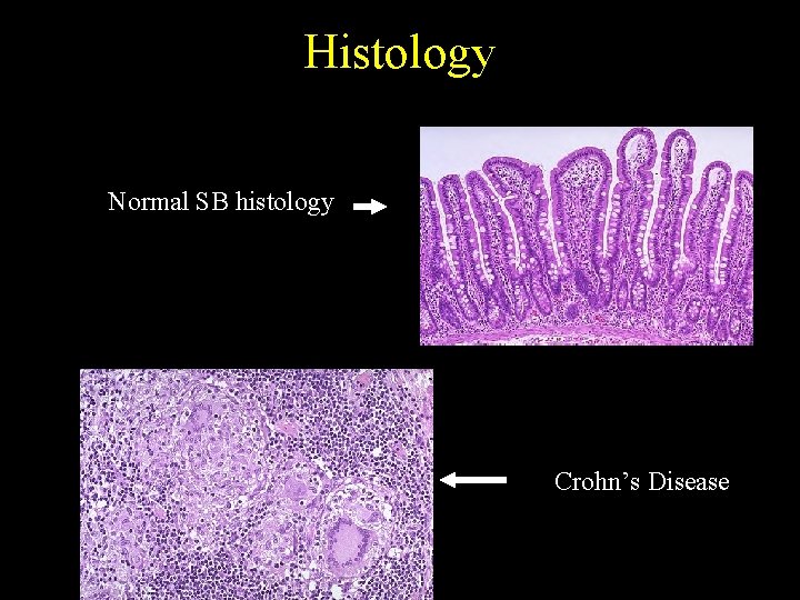 Histology Normal SB histology Crohn’s Disease 