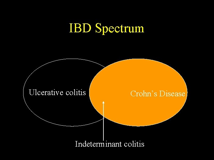 IBD Spectrum Ulcerative colitis Crohn’s Disease Indeterminant colitis 