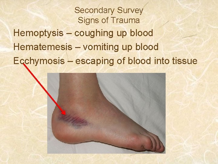 Secondary Survey Signs of Trauma Hemoptysis – coughing up blood Hematemesis – vomiting up