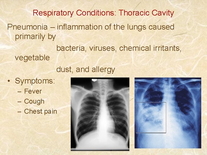 Respiratory Conditions: Thoracic Cavity Pneumonia – inflammation of the lungs caused primarily by bacteria,