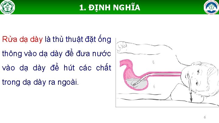 1. ĐỊNH NGHĨA Rửa dạ dày là thủ thuật đặt ống thông vào dạ