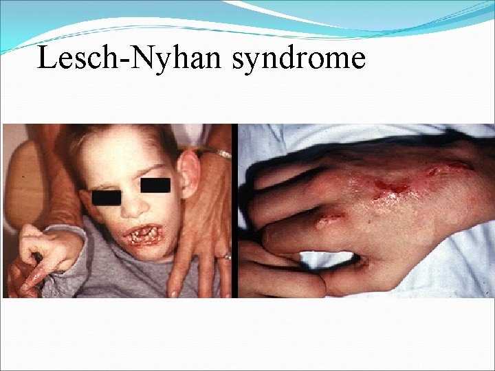 Lesch-Nyhan syndrome 