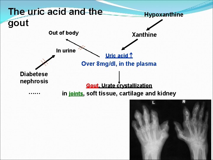 The uric acid and the gout Out of body In urine Hypoxanthine Xanthine Uric