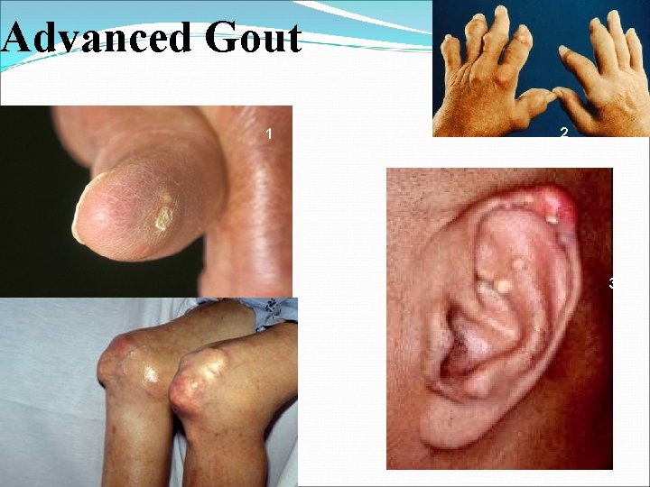 Advanced Gout 2 1 1 3 