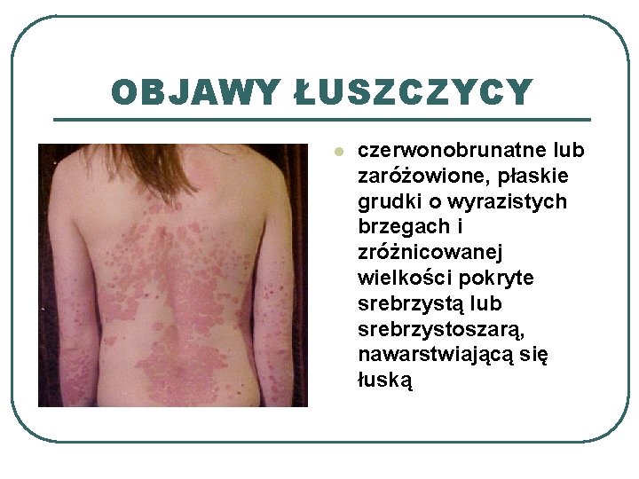 OBJAWY ŁUSZCZYCY l czerwonobrunatne lub zaróżowione, płaskie grudki o wyrazistych brzegach i zróżnicowanej wielkości