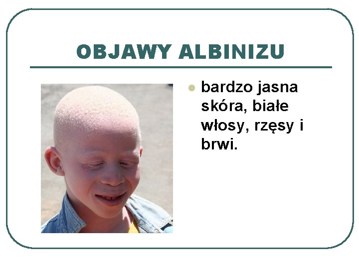 OBJAWY ALBINIZU l bardzo jasna skóra, białe włosy, rzęsy i brwi. 