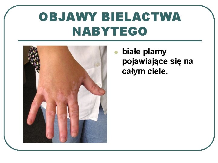 OBJAWY BIELACTWA NABYTEGO l białe plamy pojawiające się na całym ciele. 