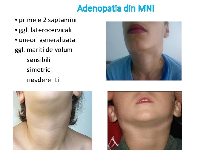 Adenopatia din MNI • primele 2 saptamini • ggl. laterocervicali • uneori generalizata ggl.