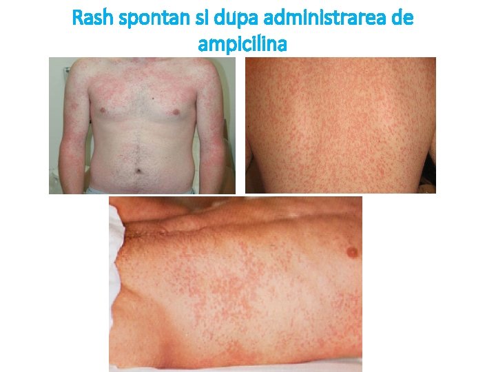 Rash spontan si dupa administrarea de ampicilina 