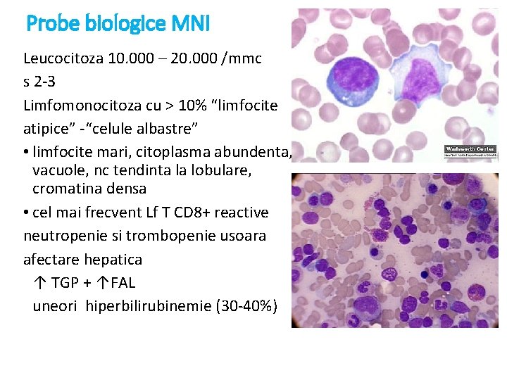 Probe biologice MNI Leucocitoza 10. 000 – 20. 000 /mmc s 2 -3 Limfomonocitoza